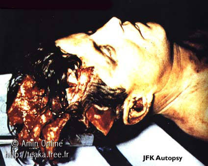 kennedy assassination autopsy pictures. side of Kennedy#39;s head,